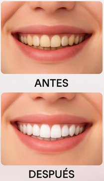 Resultado después del uso del Kit Sonrisa